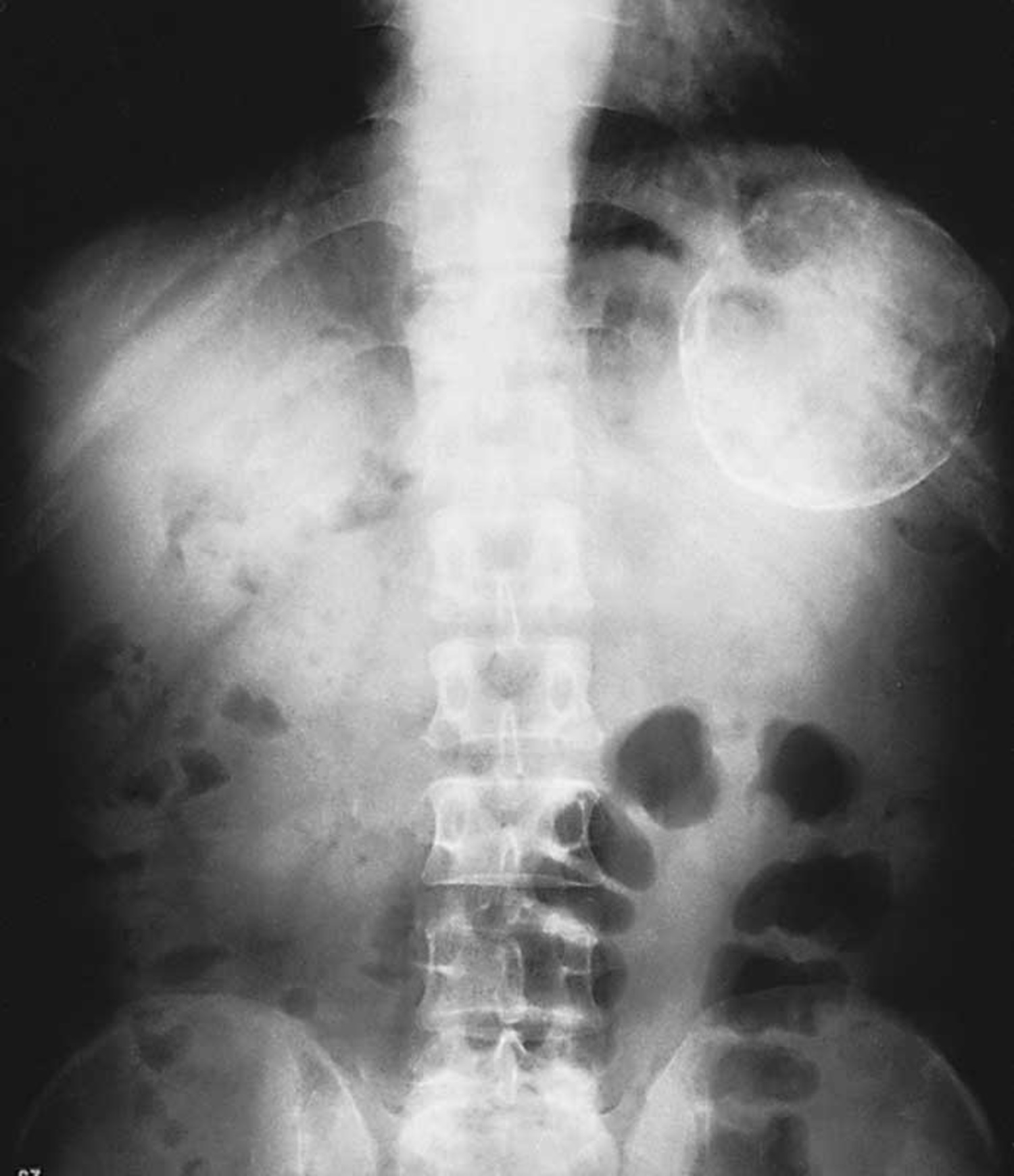 Splenic cyst
