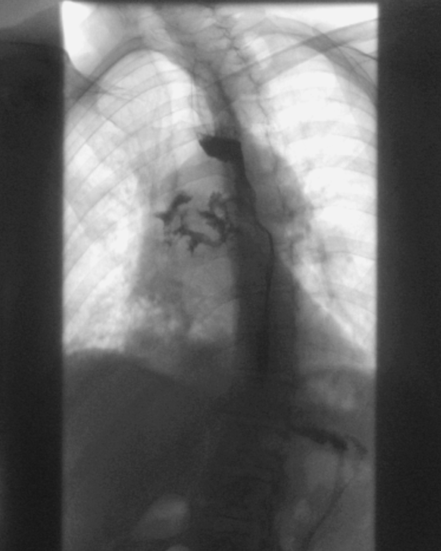 Bronchoesophageal fistula