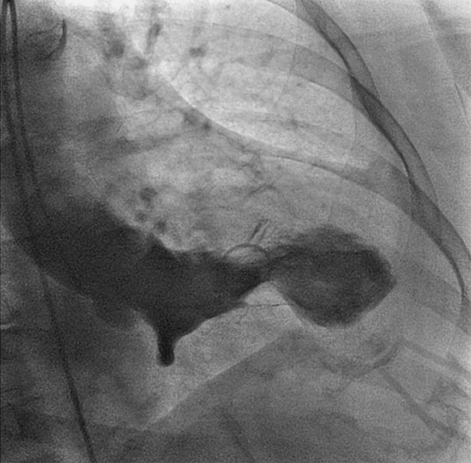 Takotsubo cardiomyopathy
