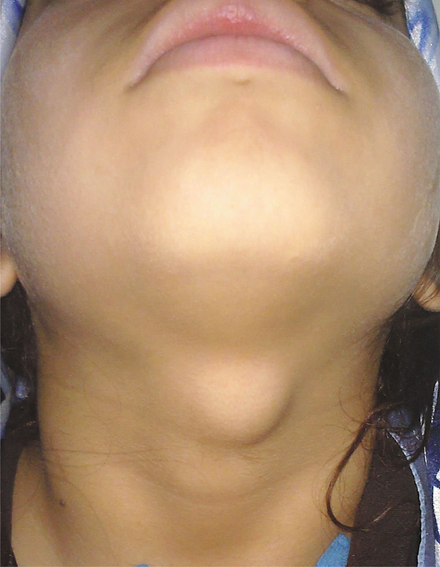 Ectopic thyroid