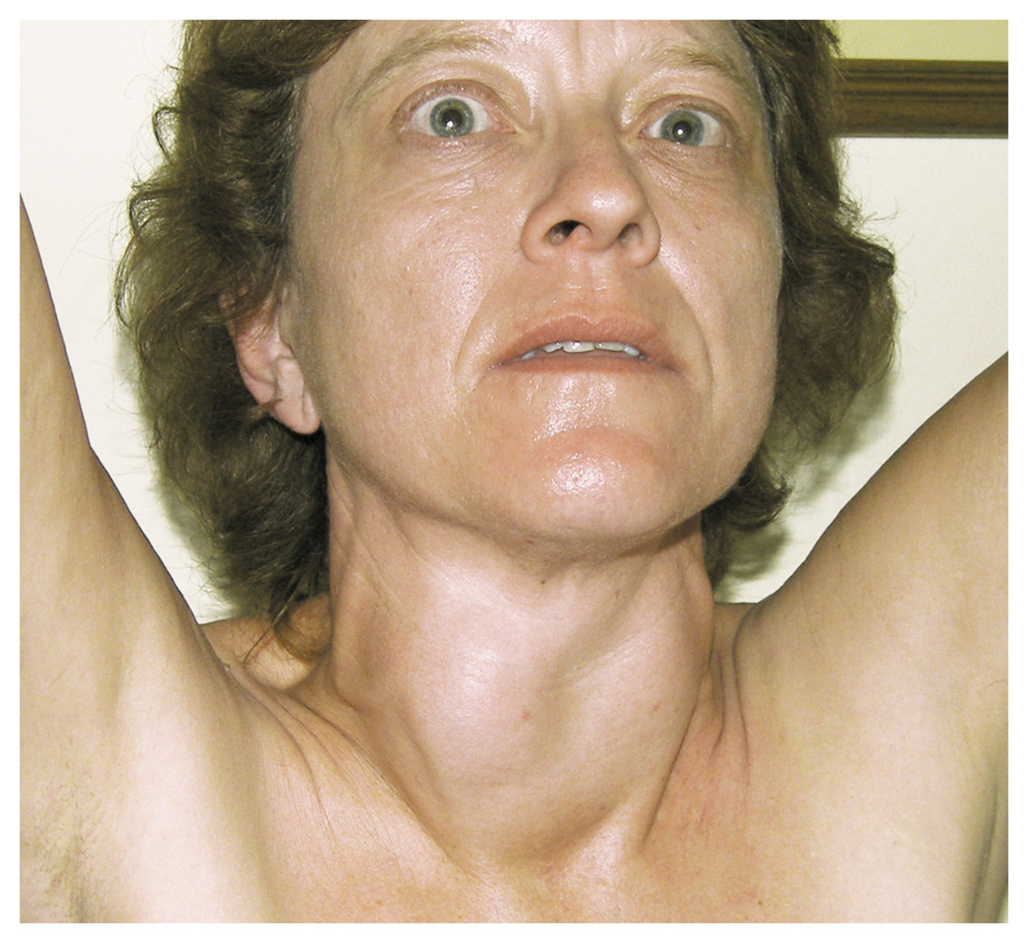 Graves' disease