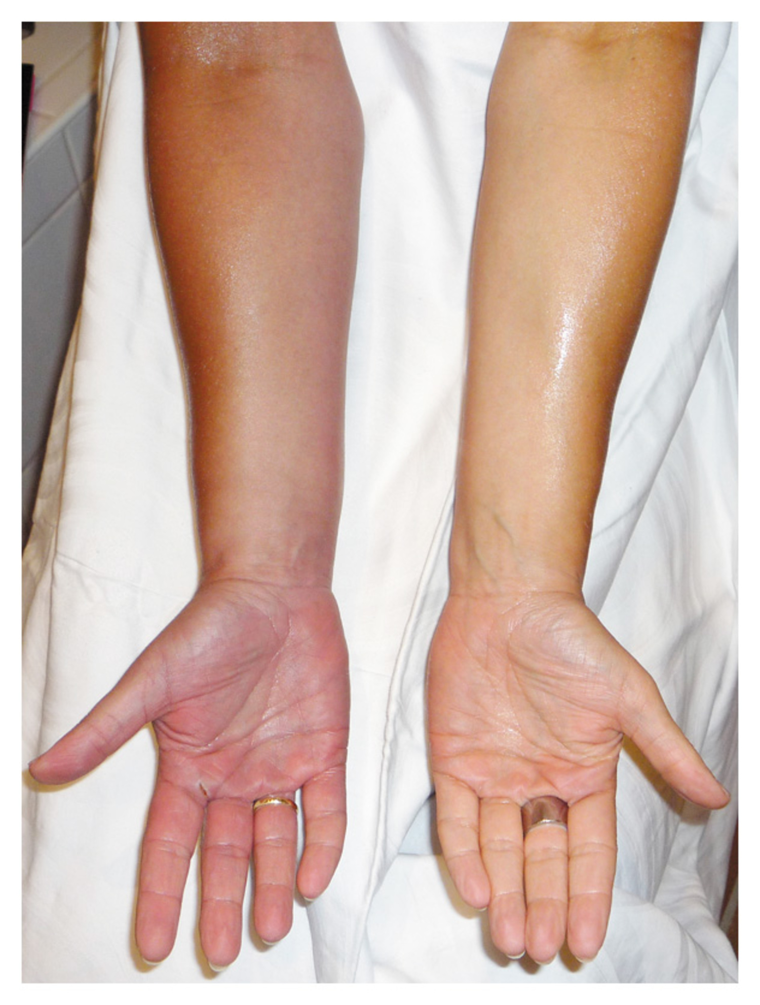 Subclavian vein thrombosis