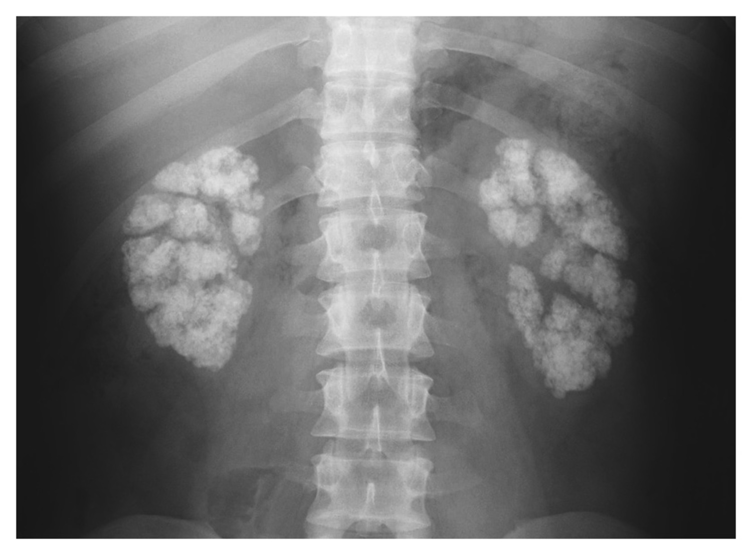 Renal tubular acidosis