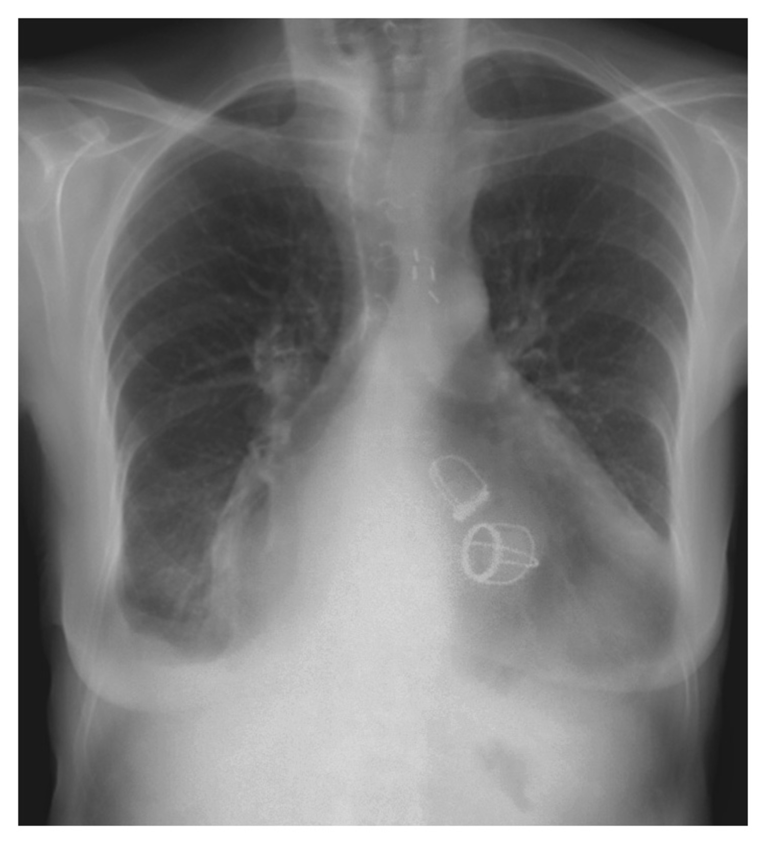 Aortic and mitral valves