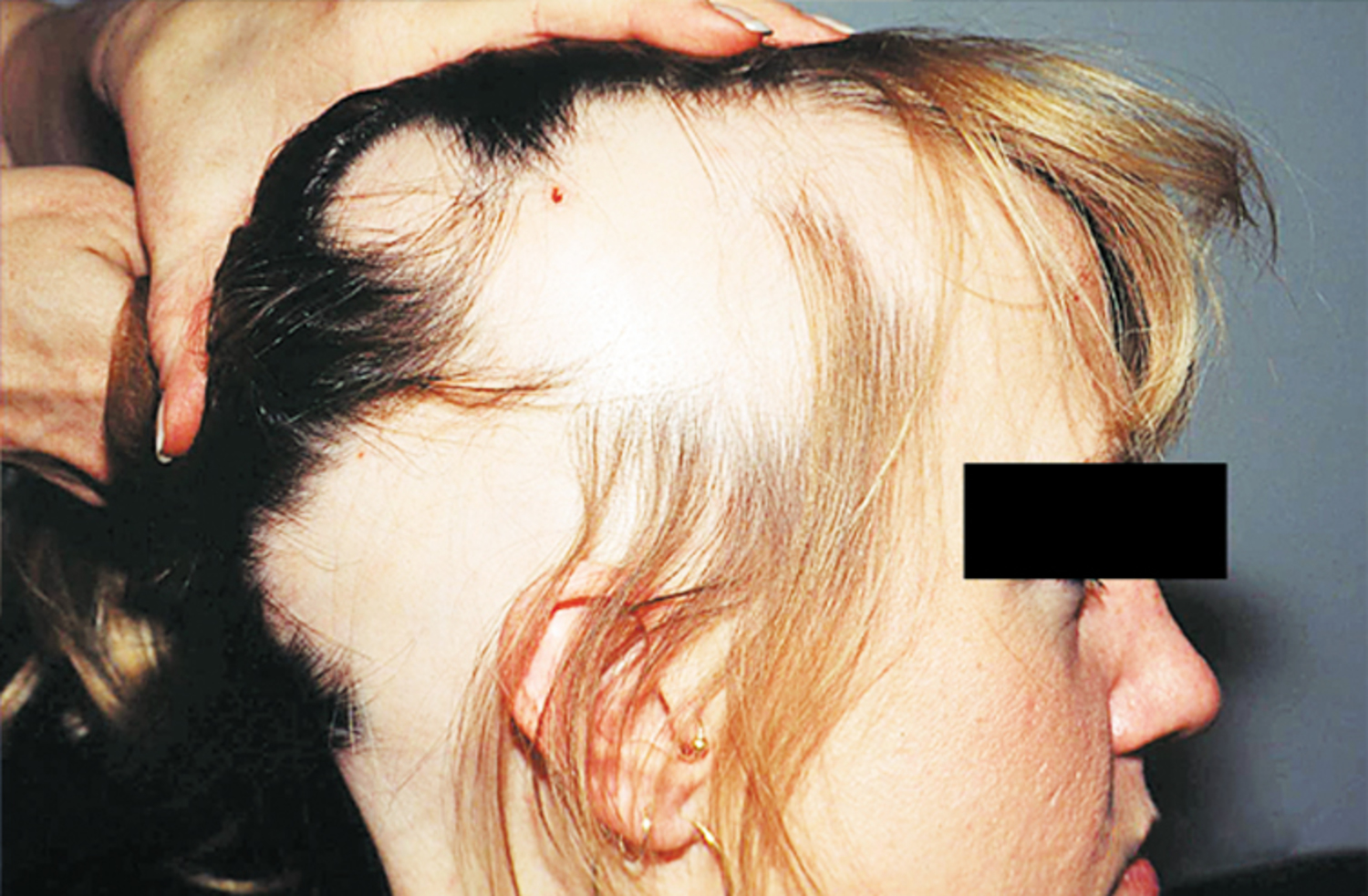 Alopecia areata