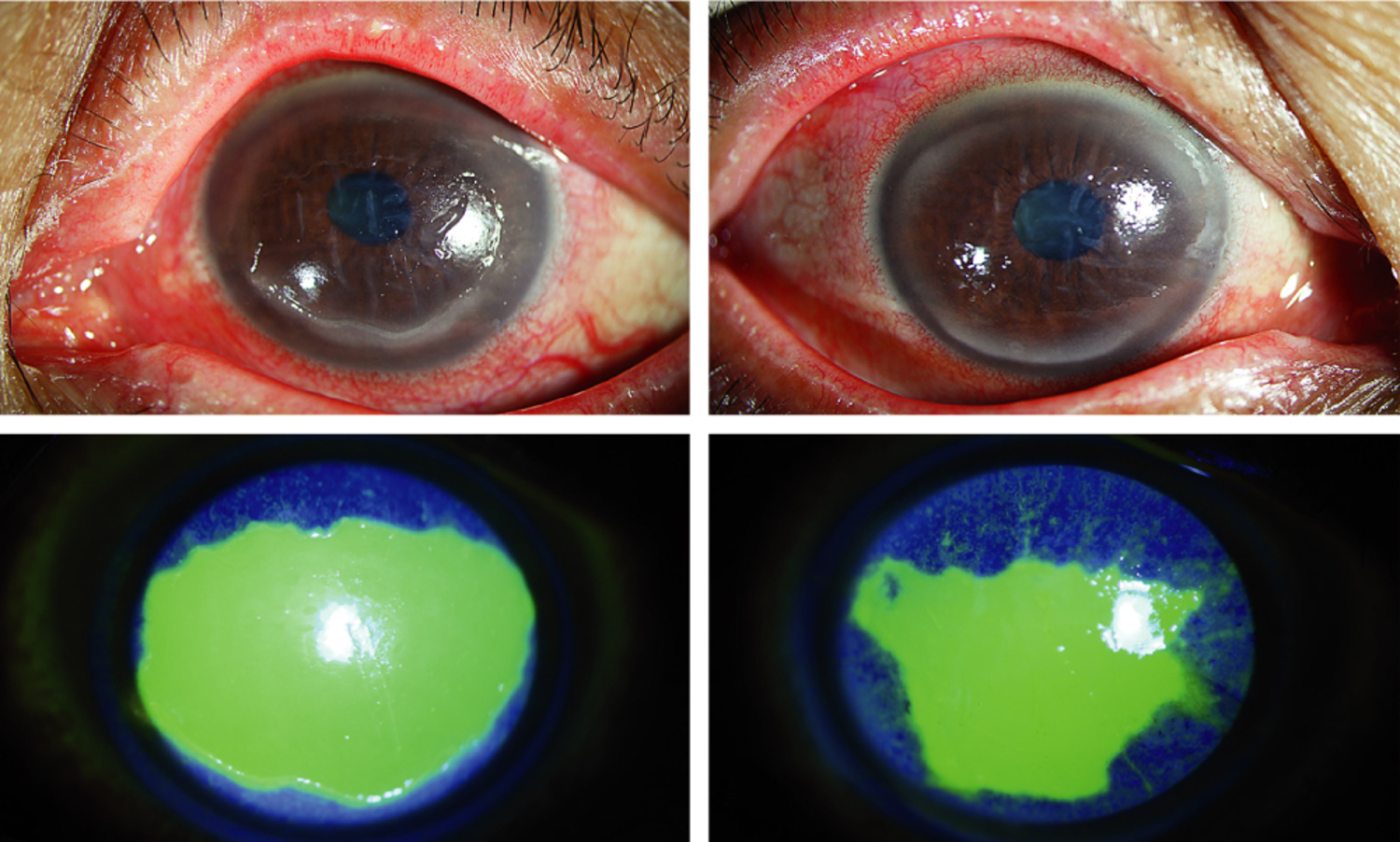 Sjögren's syndrome