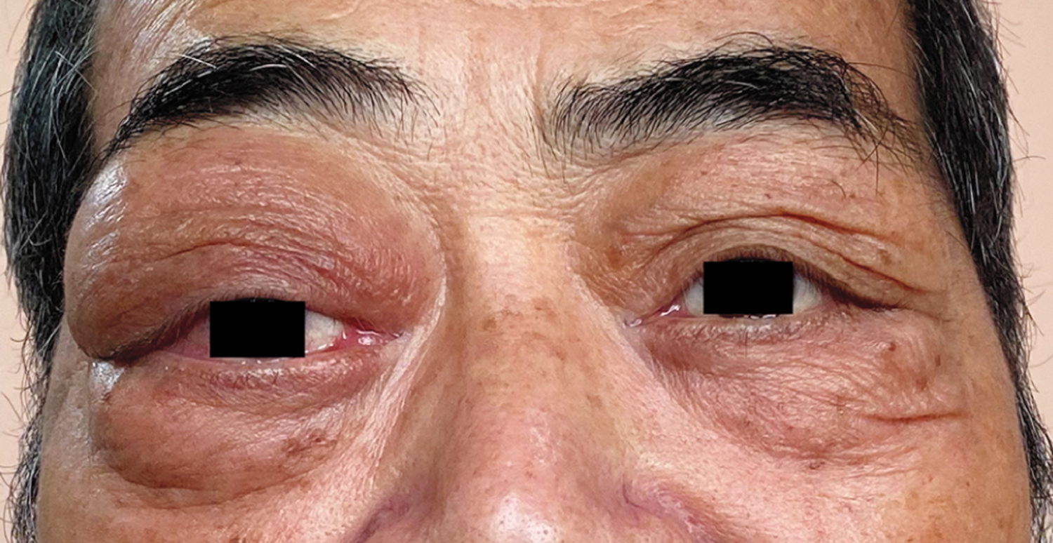 IgG4-related ophthalmic disease