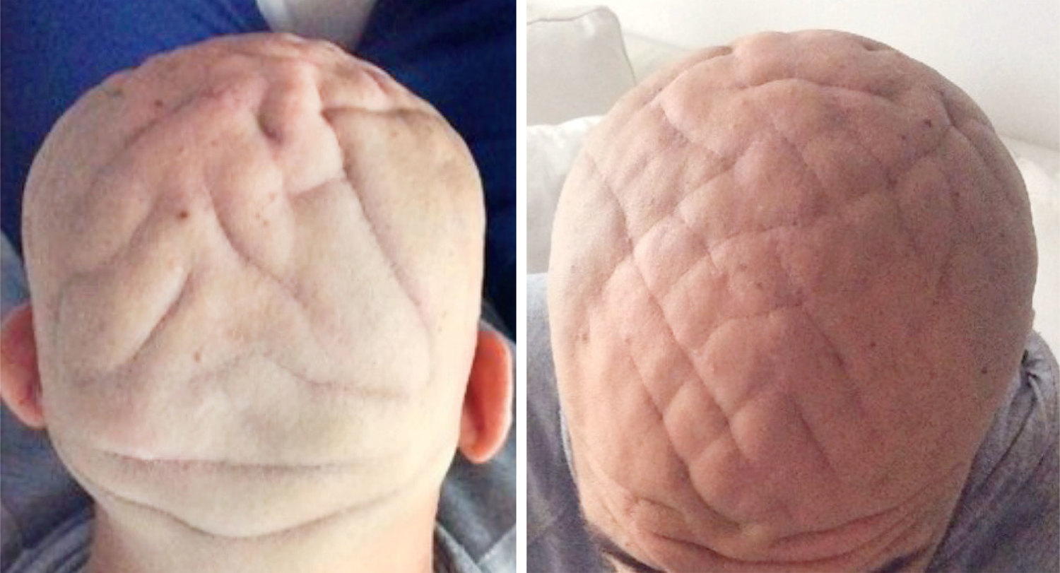 Acromegaly