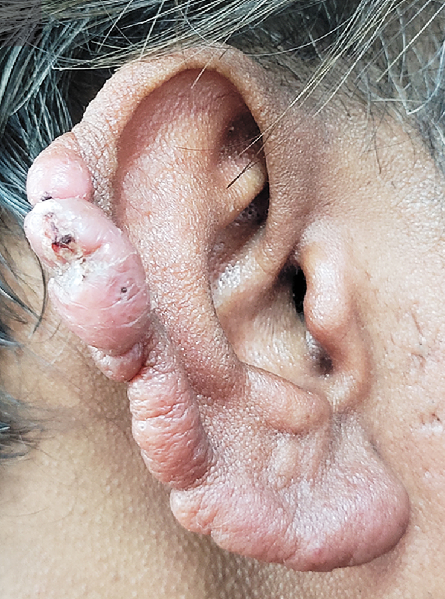 Lepromatous Leprosy