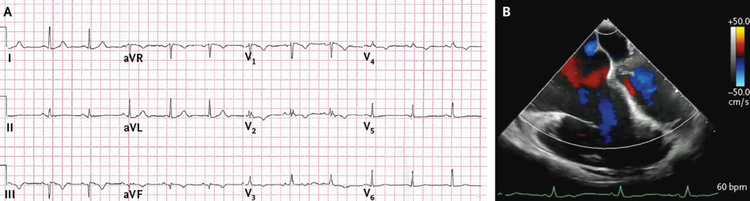 Arrhythmogenic right ventricular cardiomyopathy