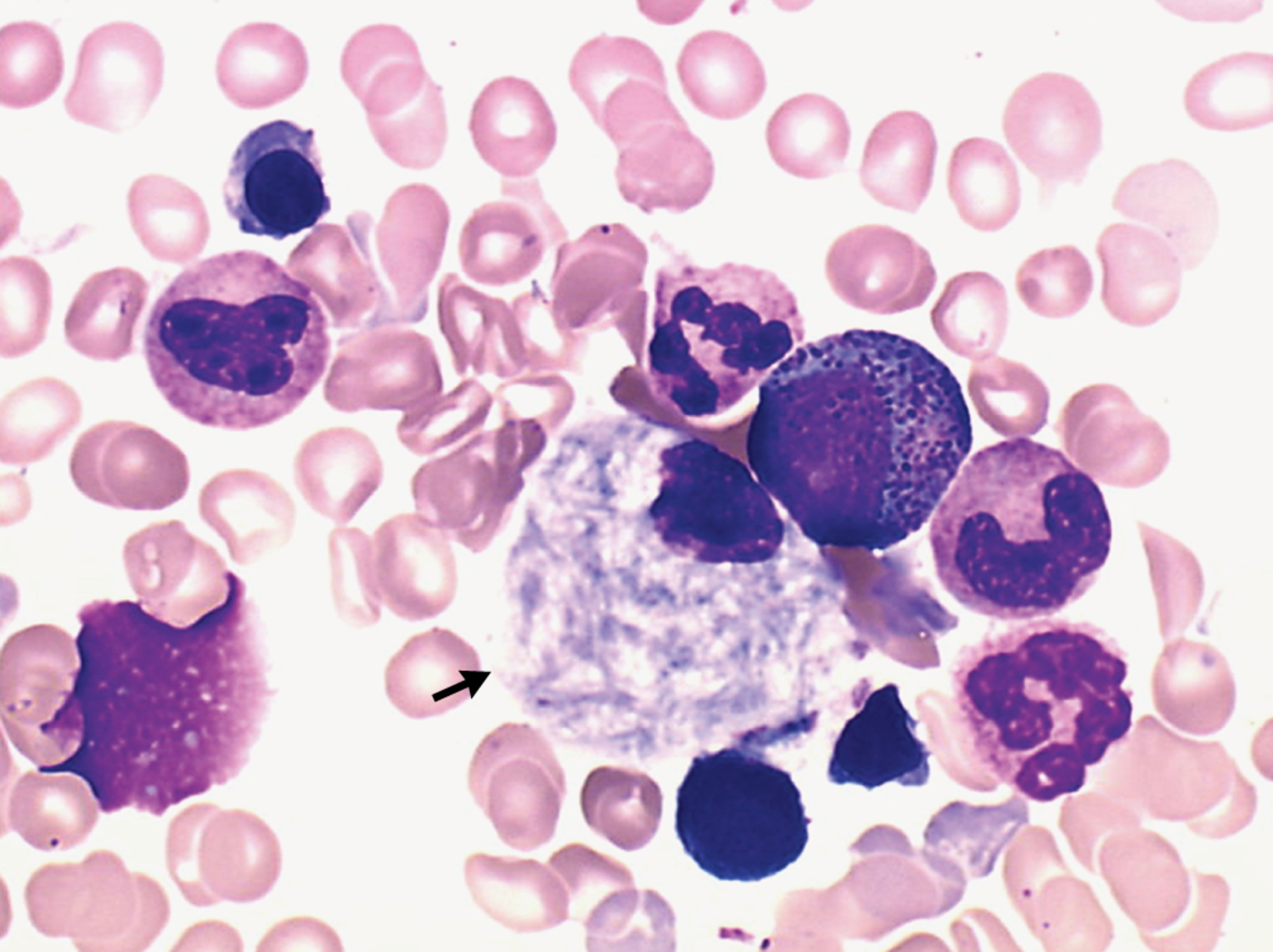 Gaucher's disease