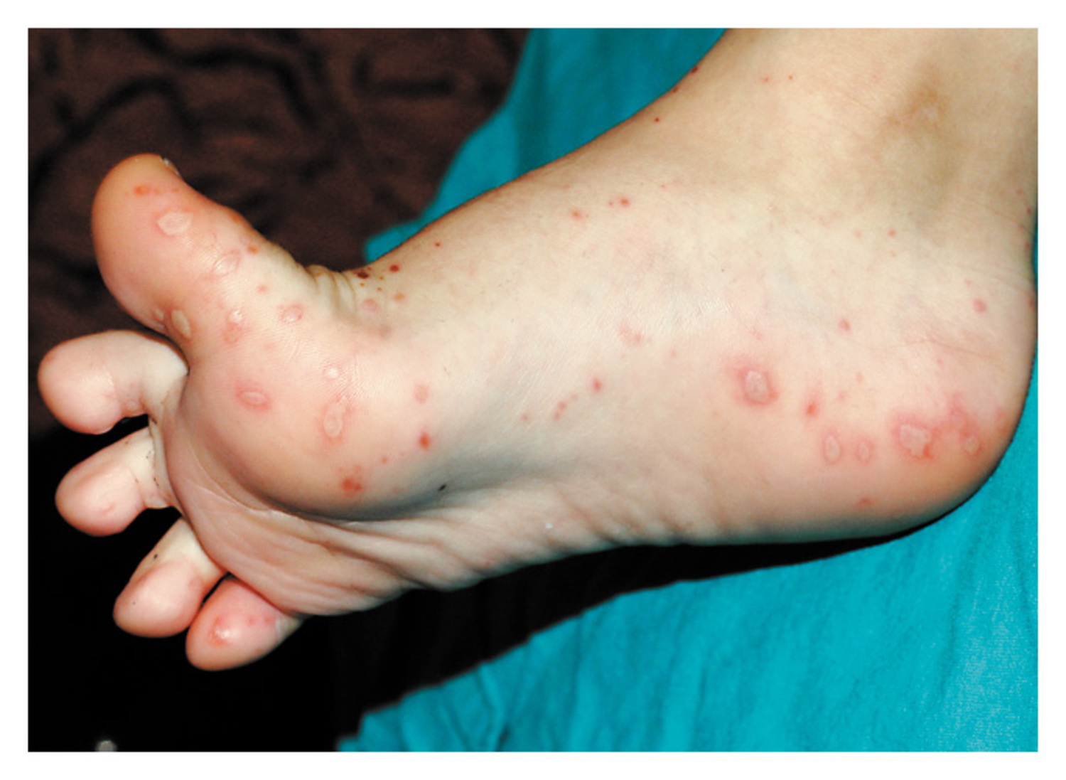 Hand, foot, and mouth disease