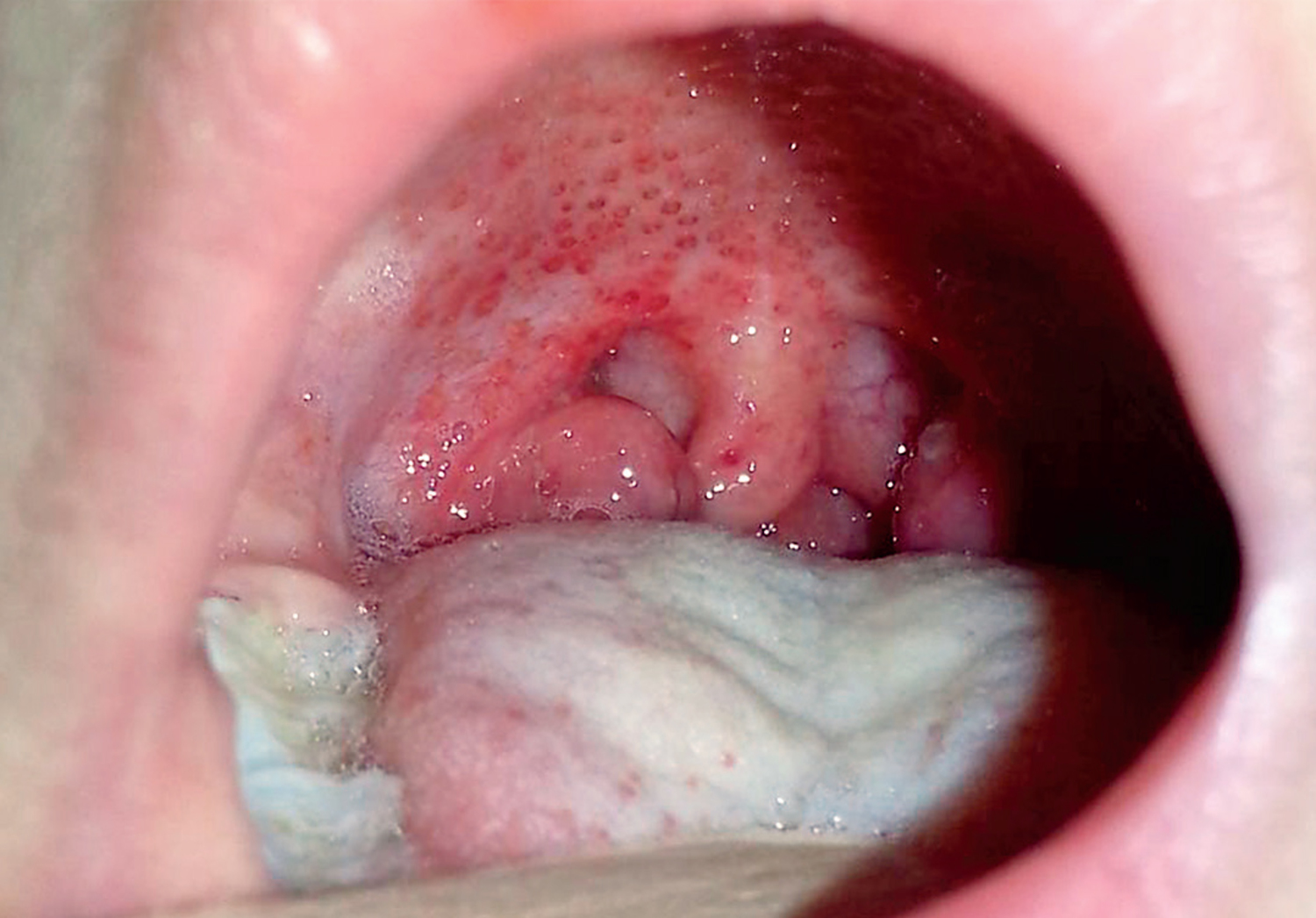 Group A streptococcus