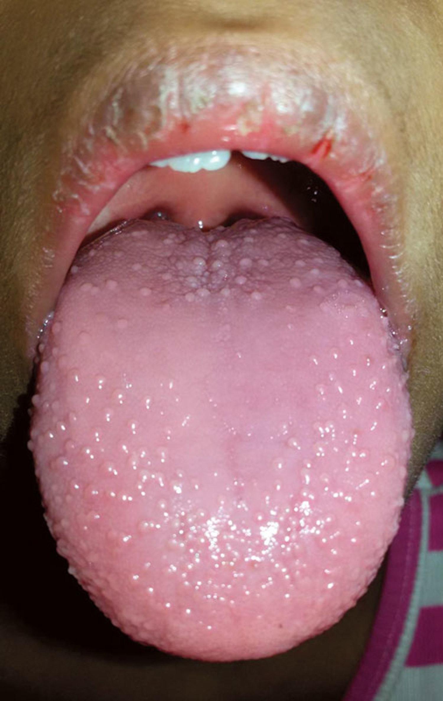 Aspirin and intravenous immune globulin