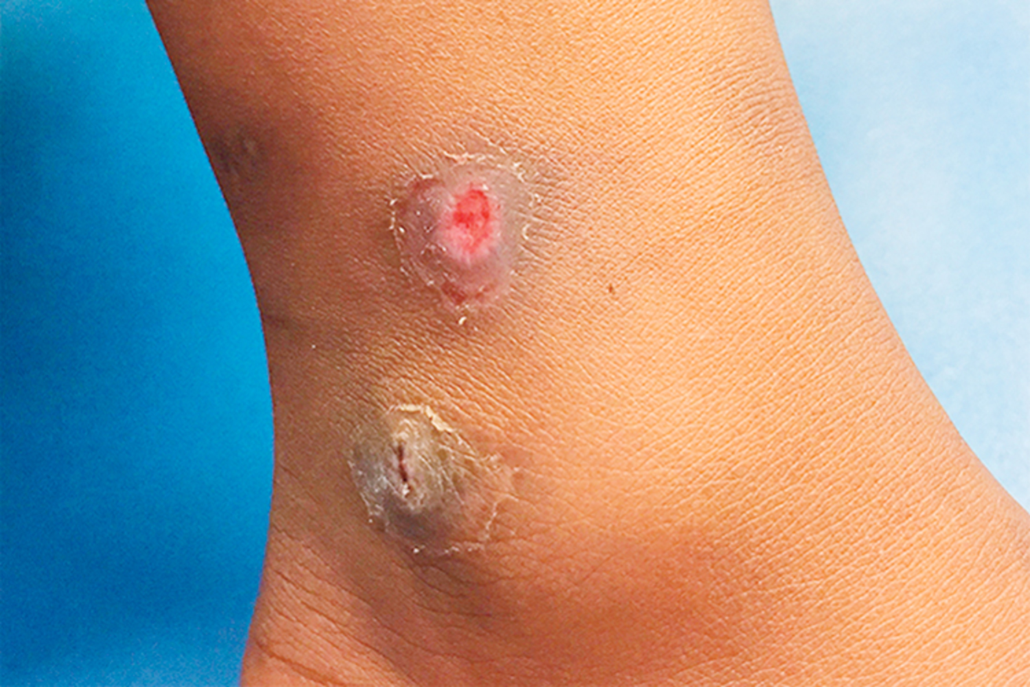 Cutaneous diphtheria