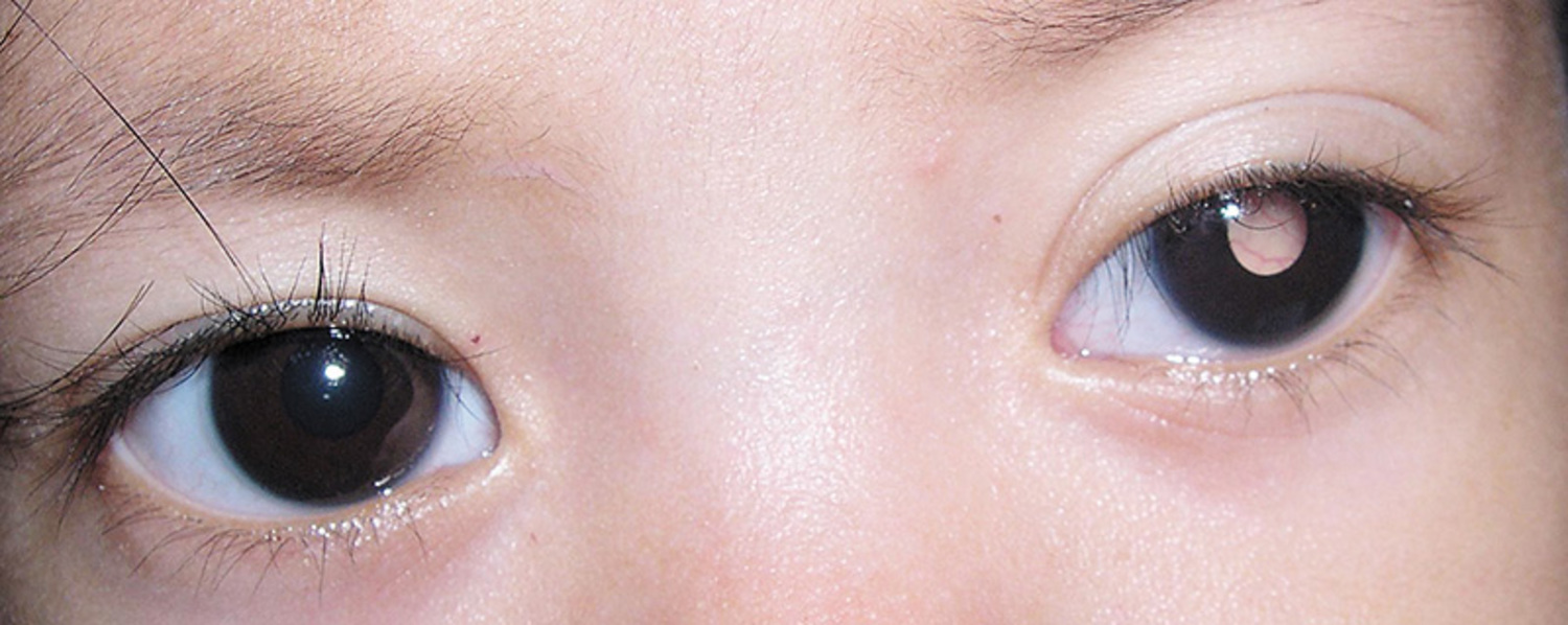 Intraocular tumor