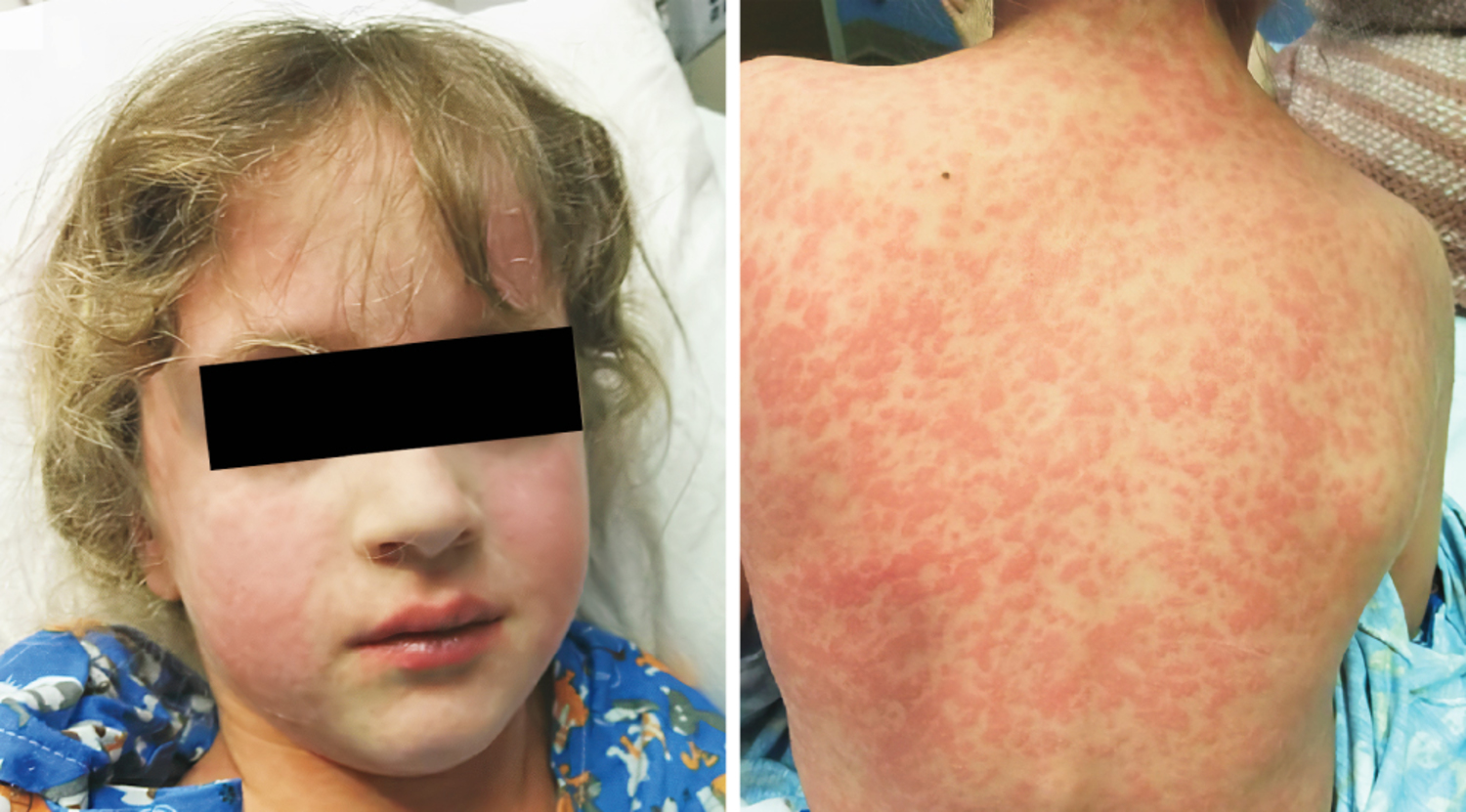 Amoxicillin rash in infectious mononucleosis