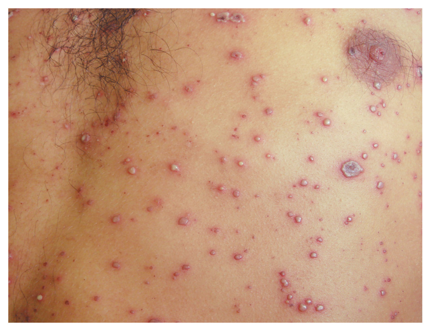 Varicella
