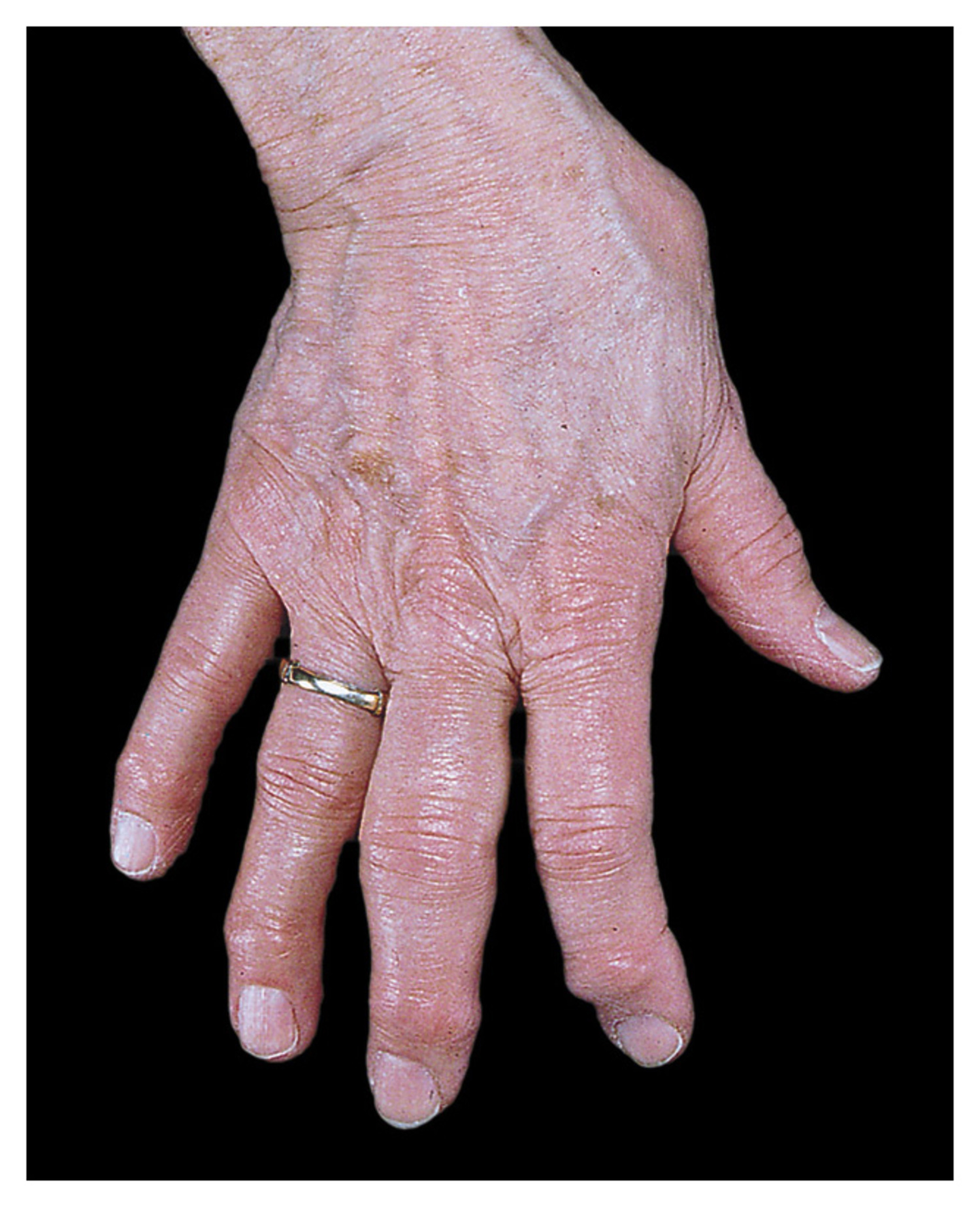 Osteoarthritis