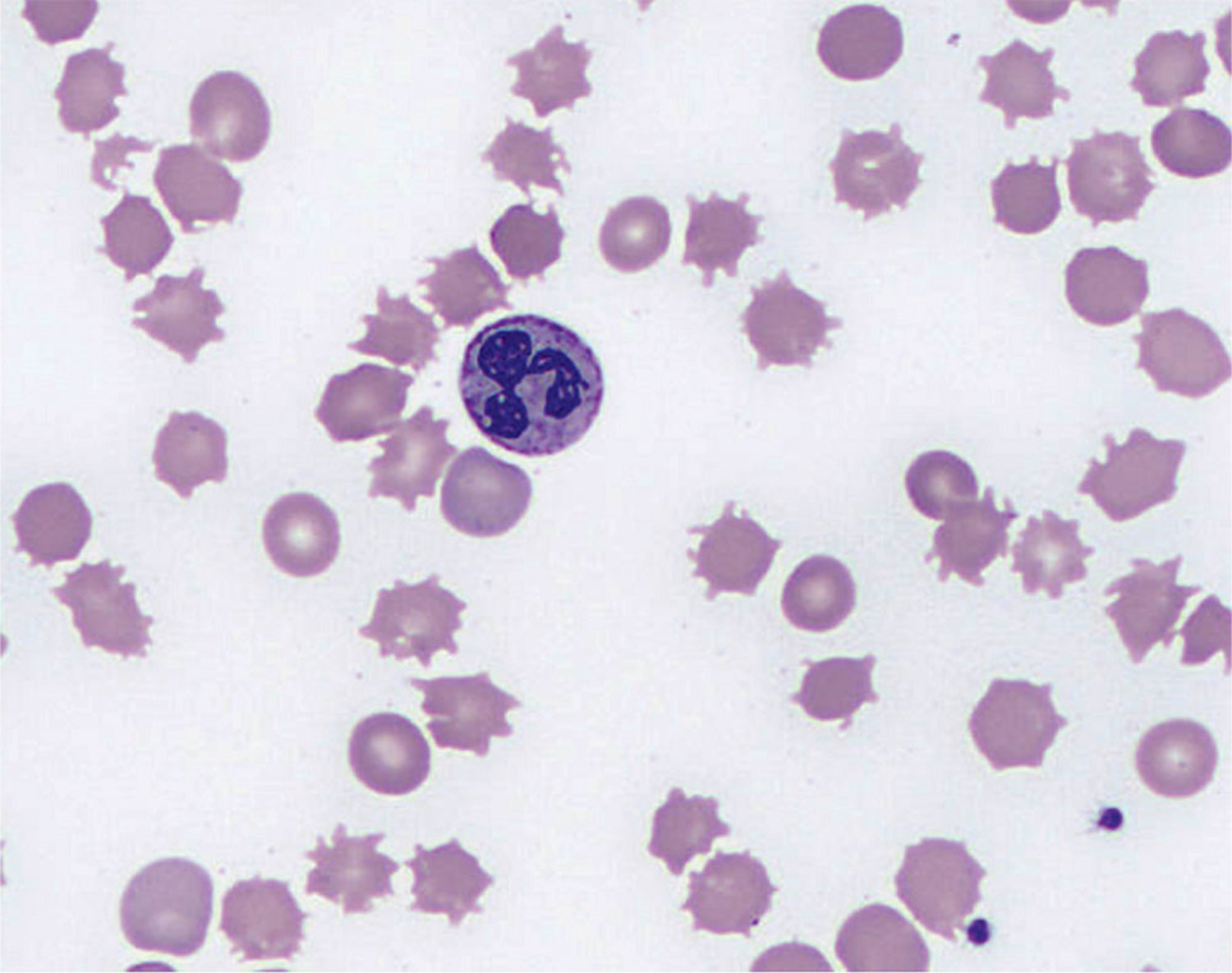 Decompensated cirrhosis