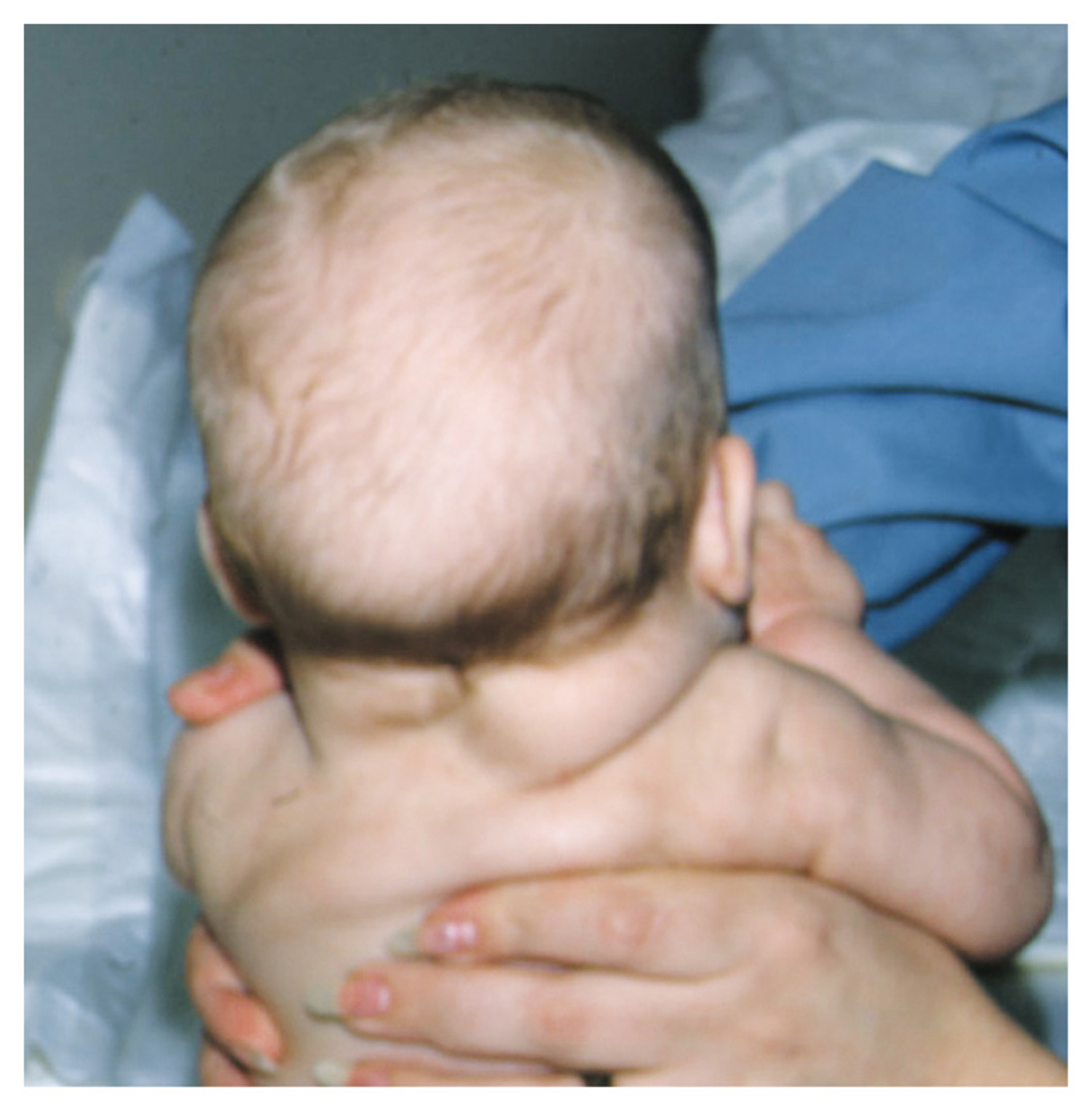 Turner syndrome