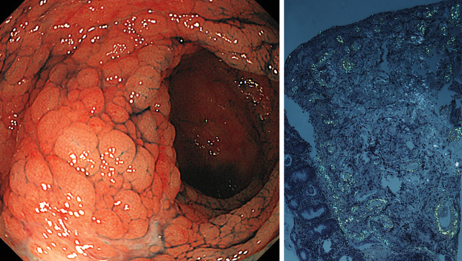 Gastrointestinal amyloidosis