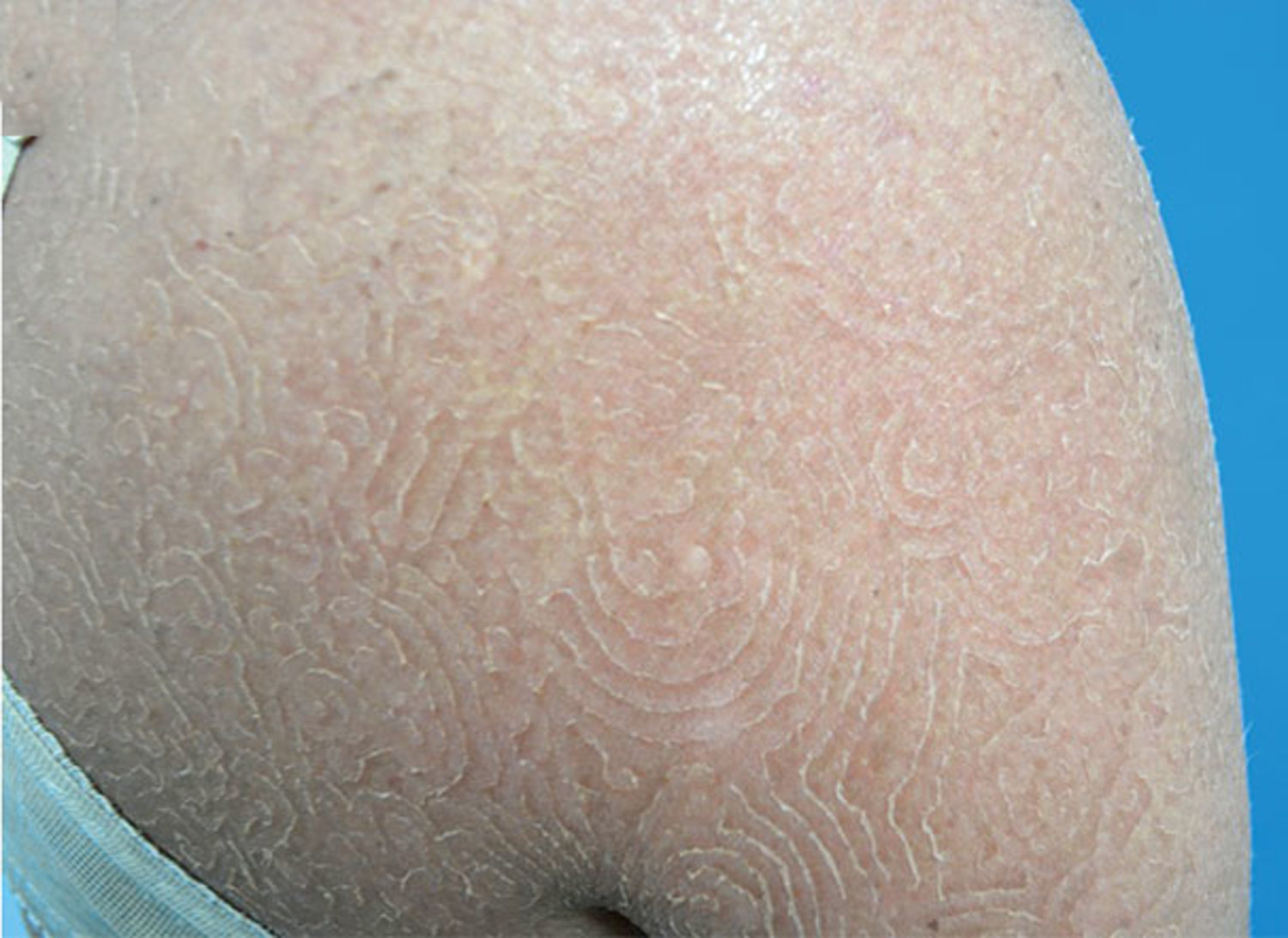 Tinea imbricata