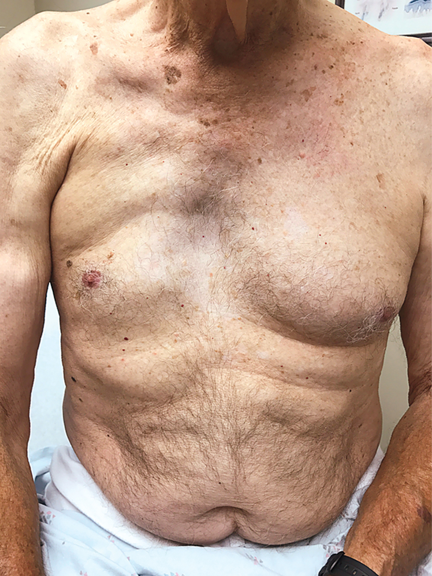 Poland syndrome