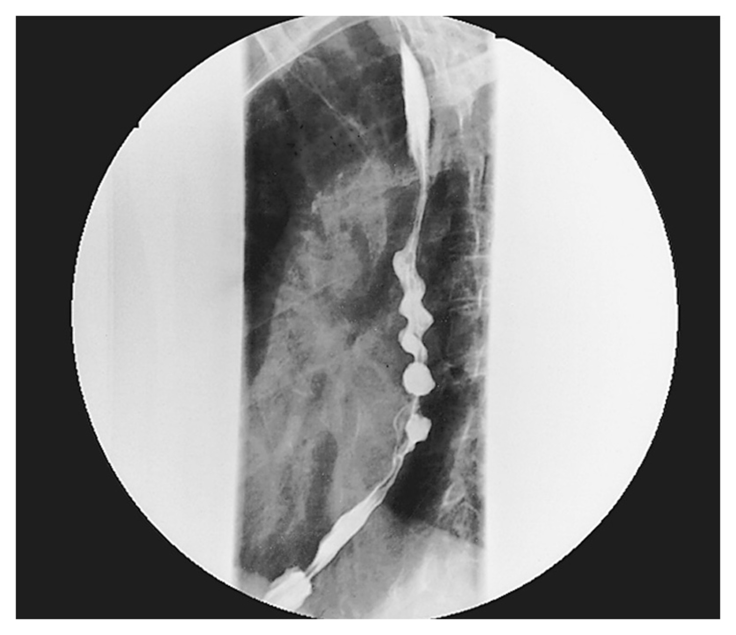 Diffuse esophageal spasm