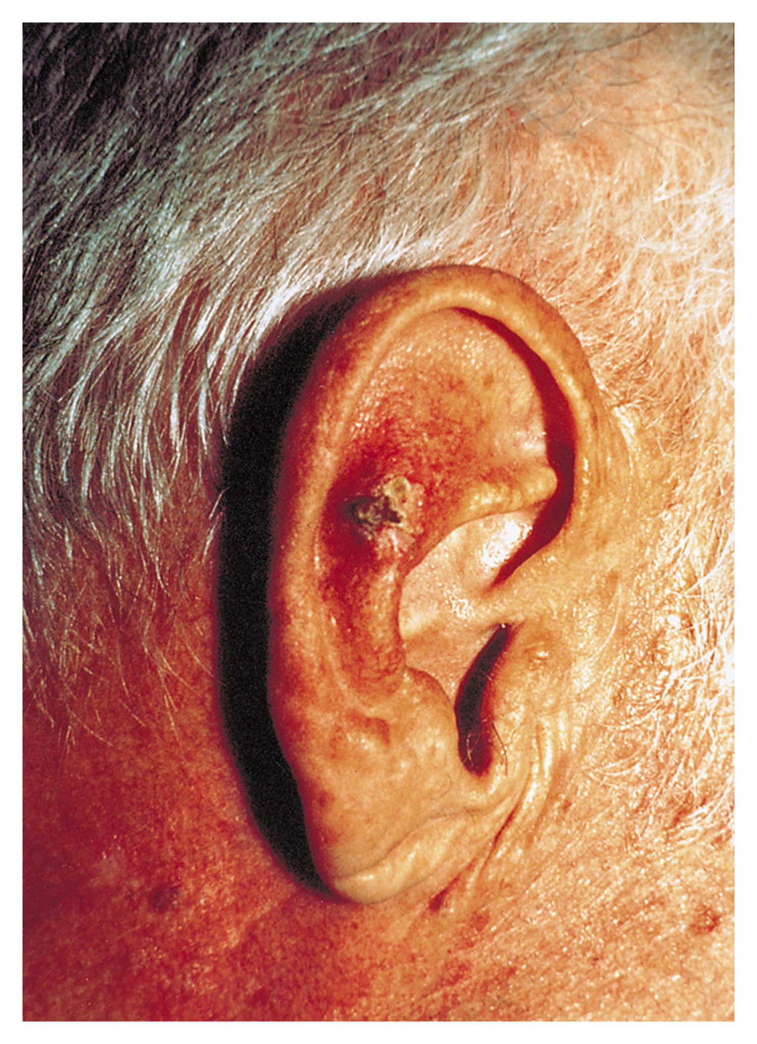 Squamous-cell carcinoma
