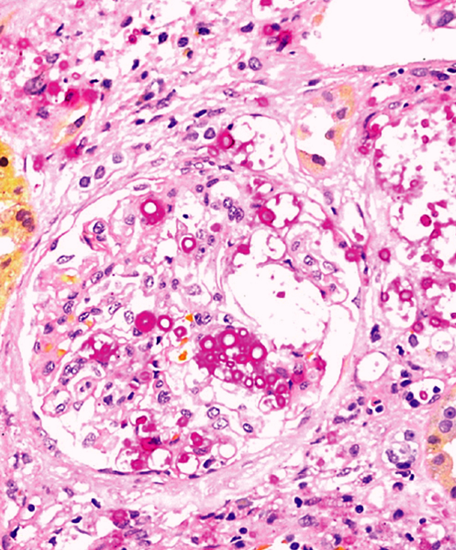 Renal cryptococcosis