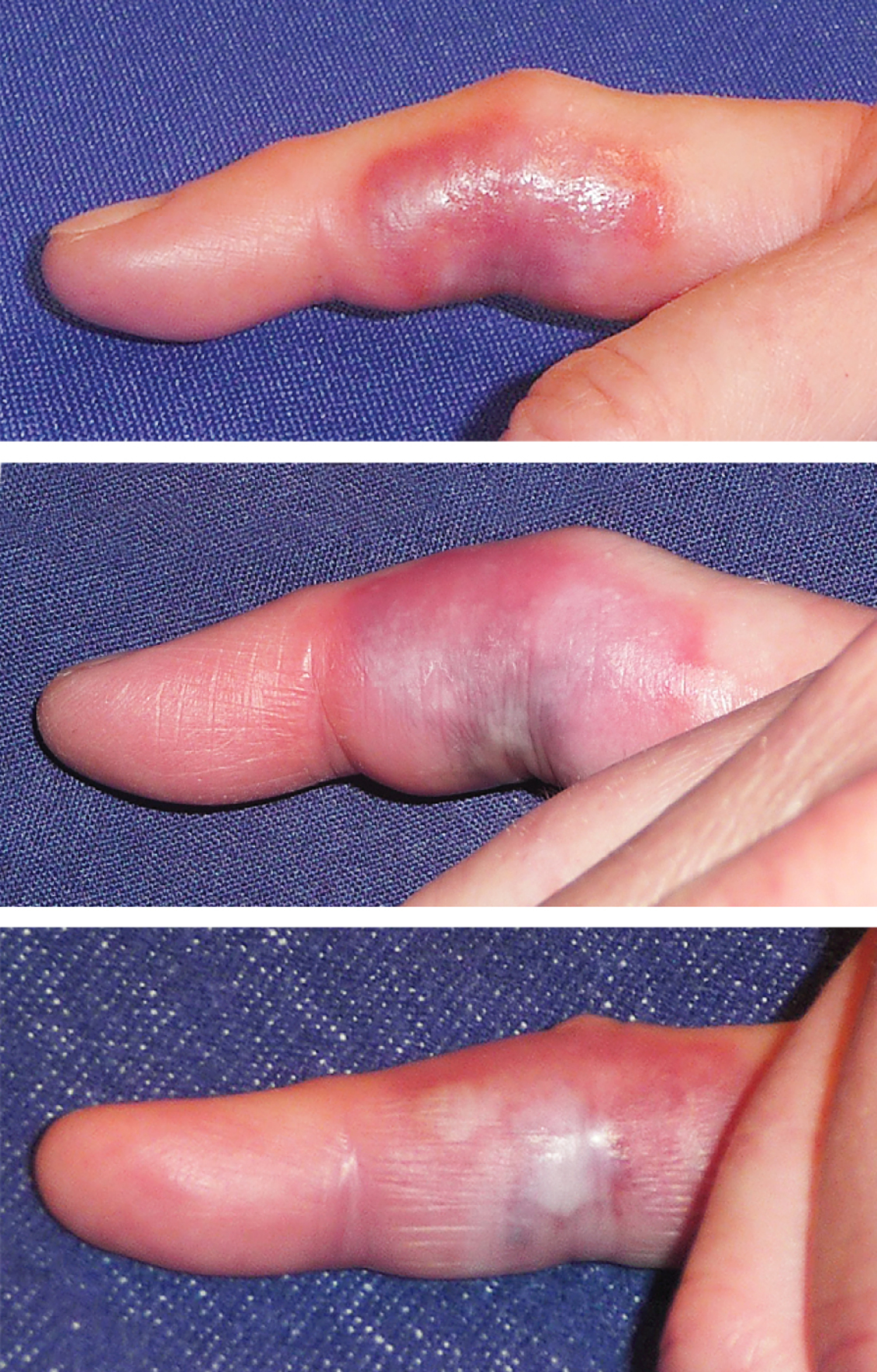 Spider bite
