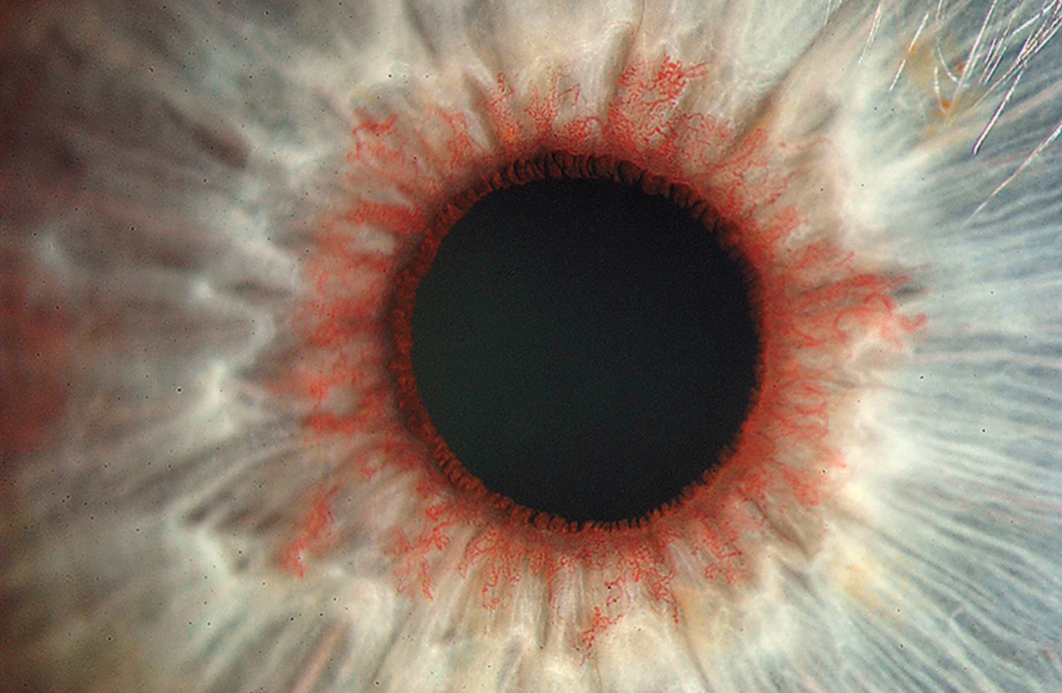 Retinal ischemia
