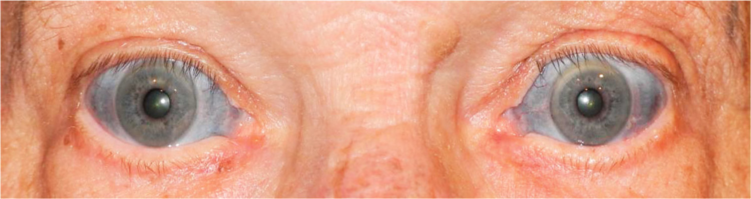 Minocycline-induced pigmentation