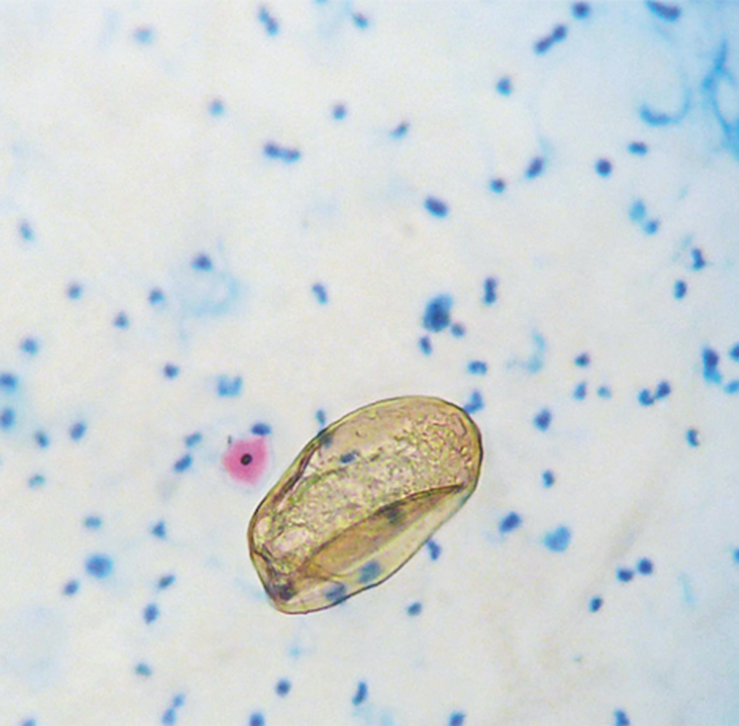 Paragonimiasis