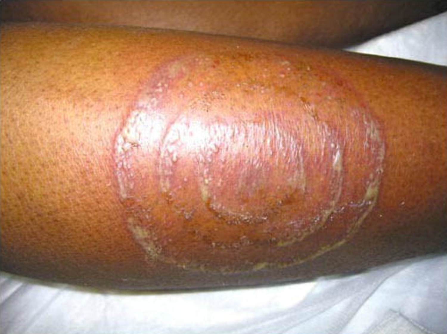 Tinea circinata
