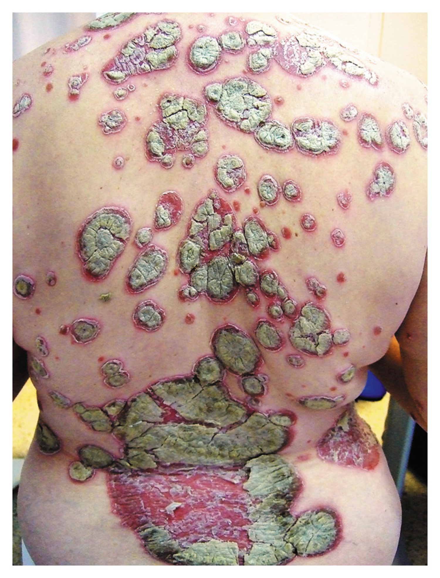 Ostraceous psoriasis