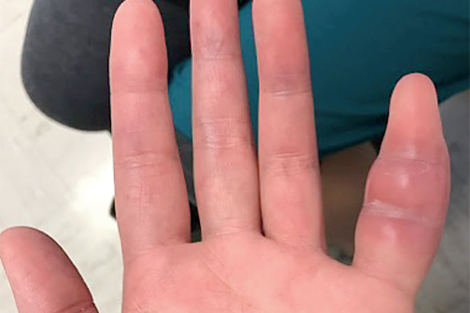 Extrapulmonary manifestation of tuberculosis
