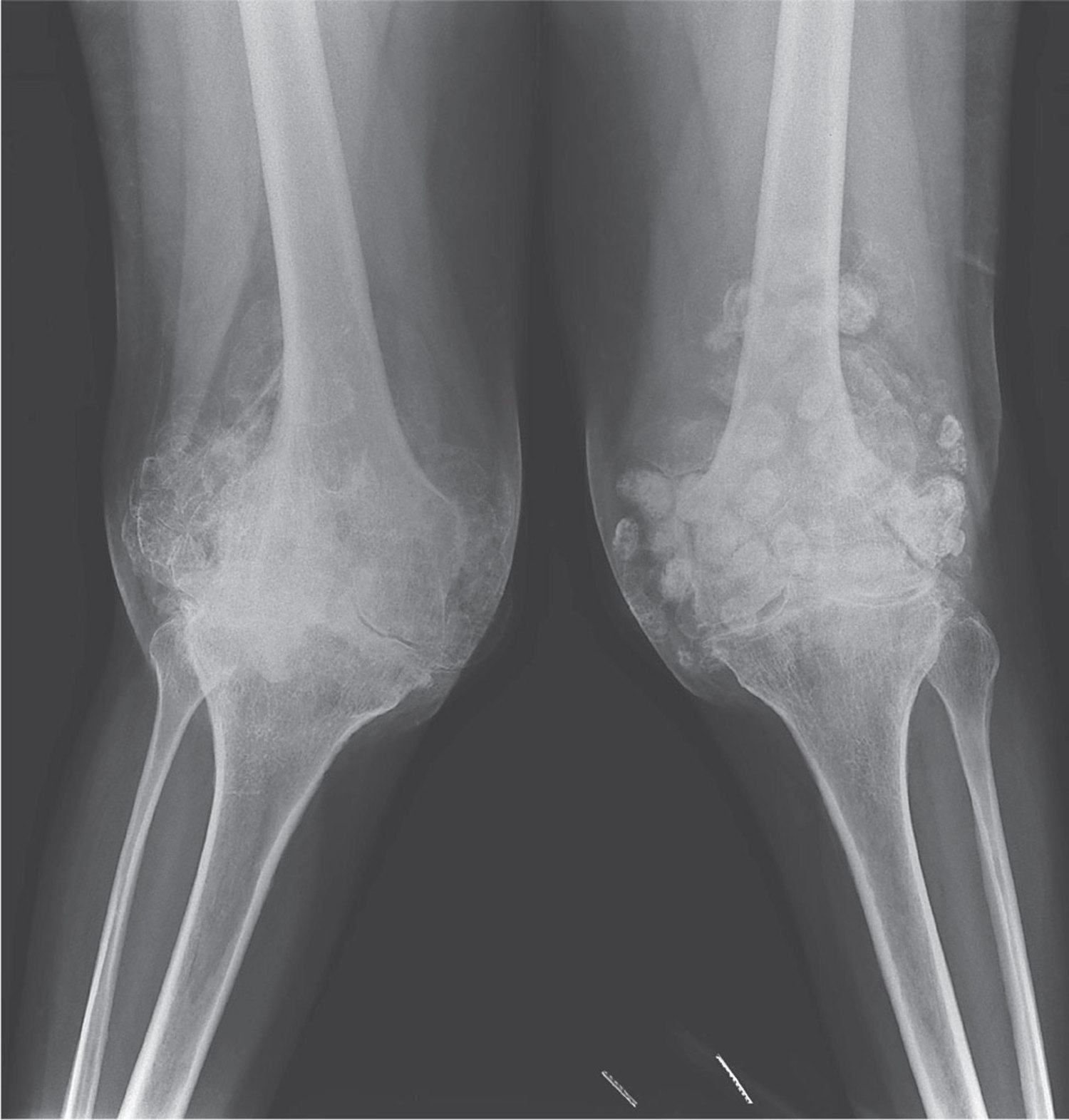 Synovial chondromatosis