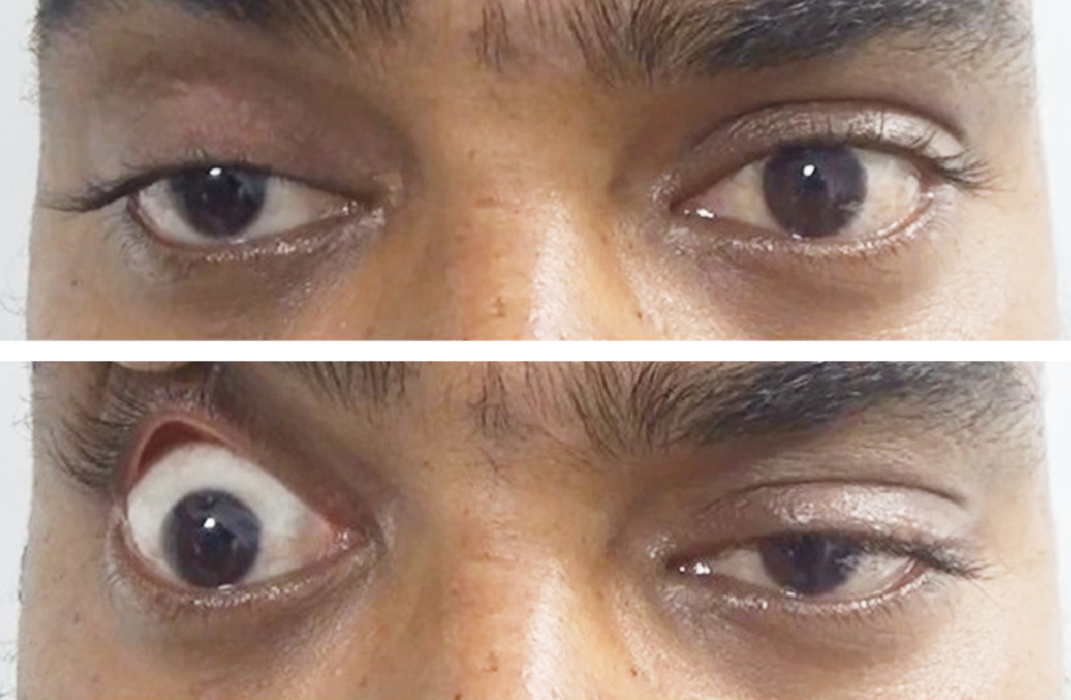 Myasthenia gravis