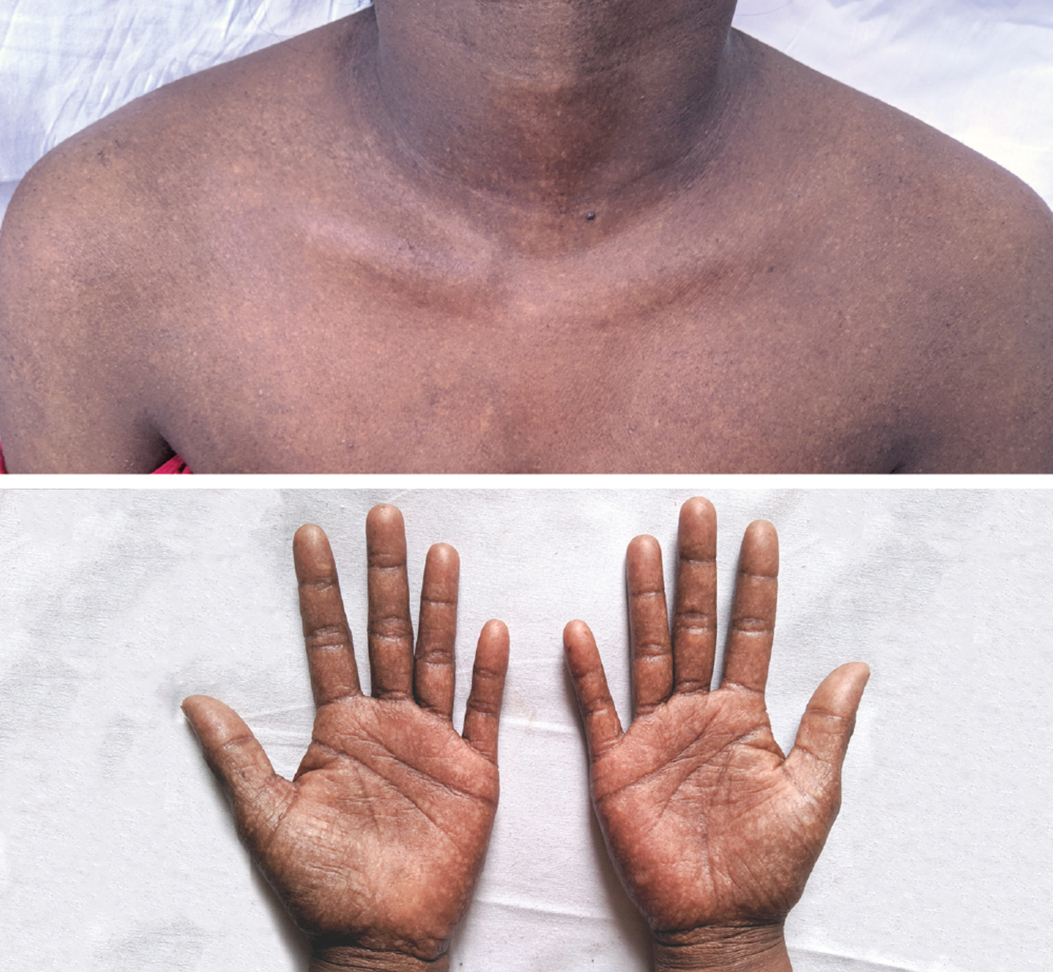 Arsenic toxicity