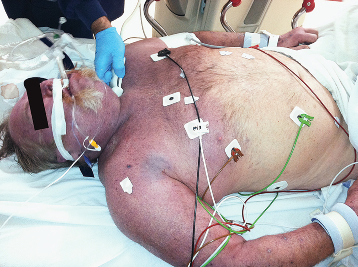 Superior vena cava syndrome
