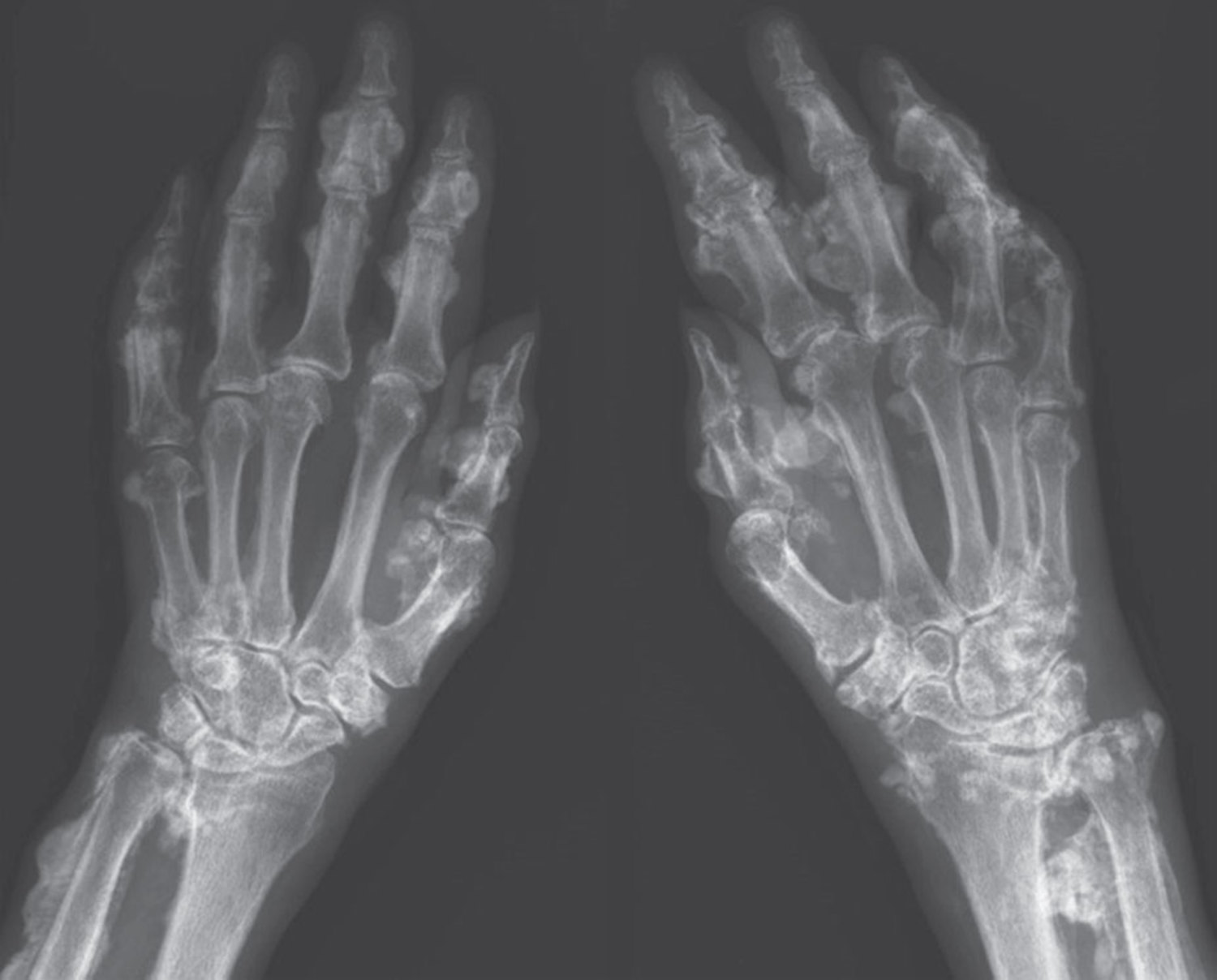 Voriconazole-induced periostitis