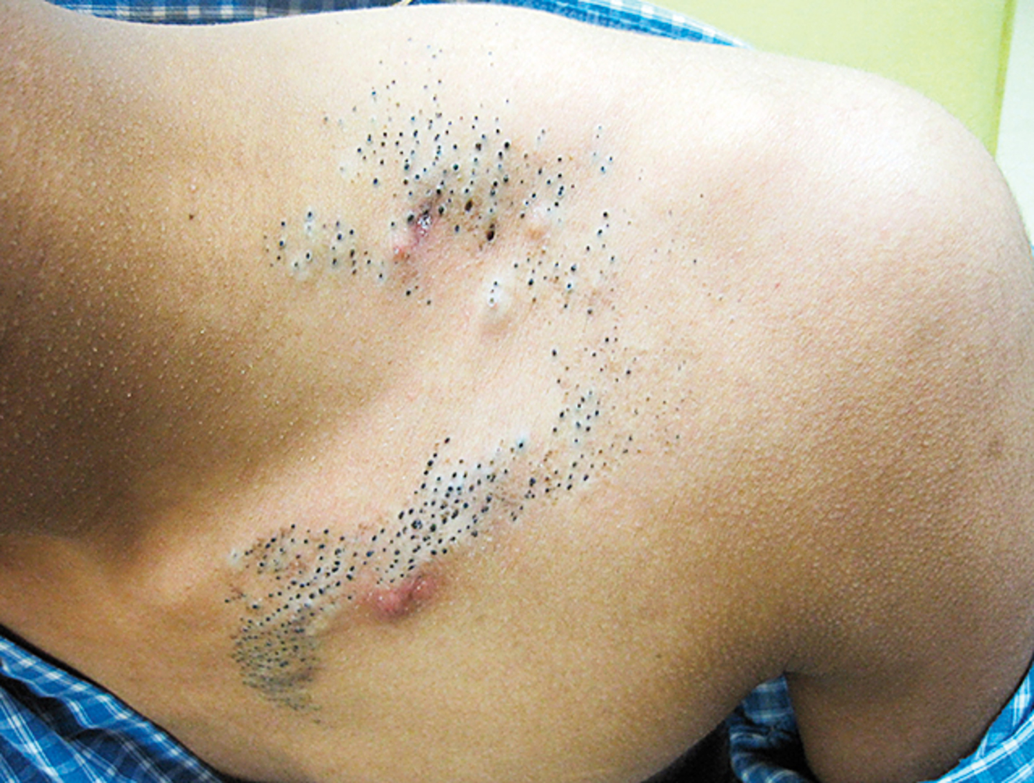 Nevus comedonicus