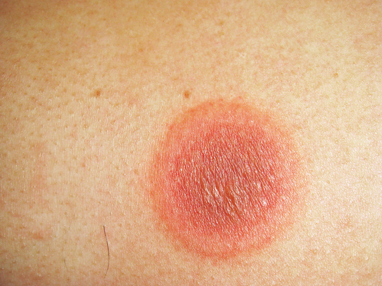Fixed drug eruption