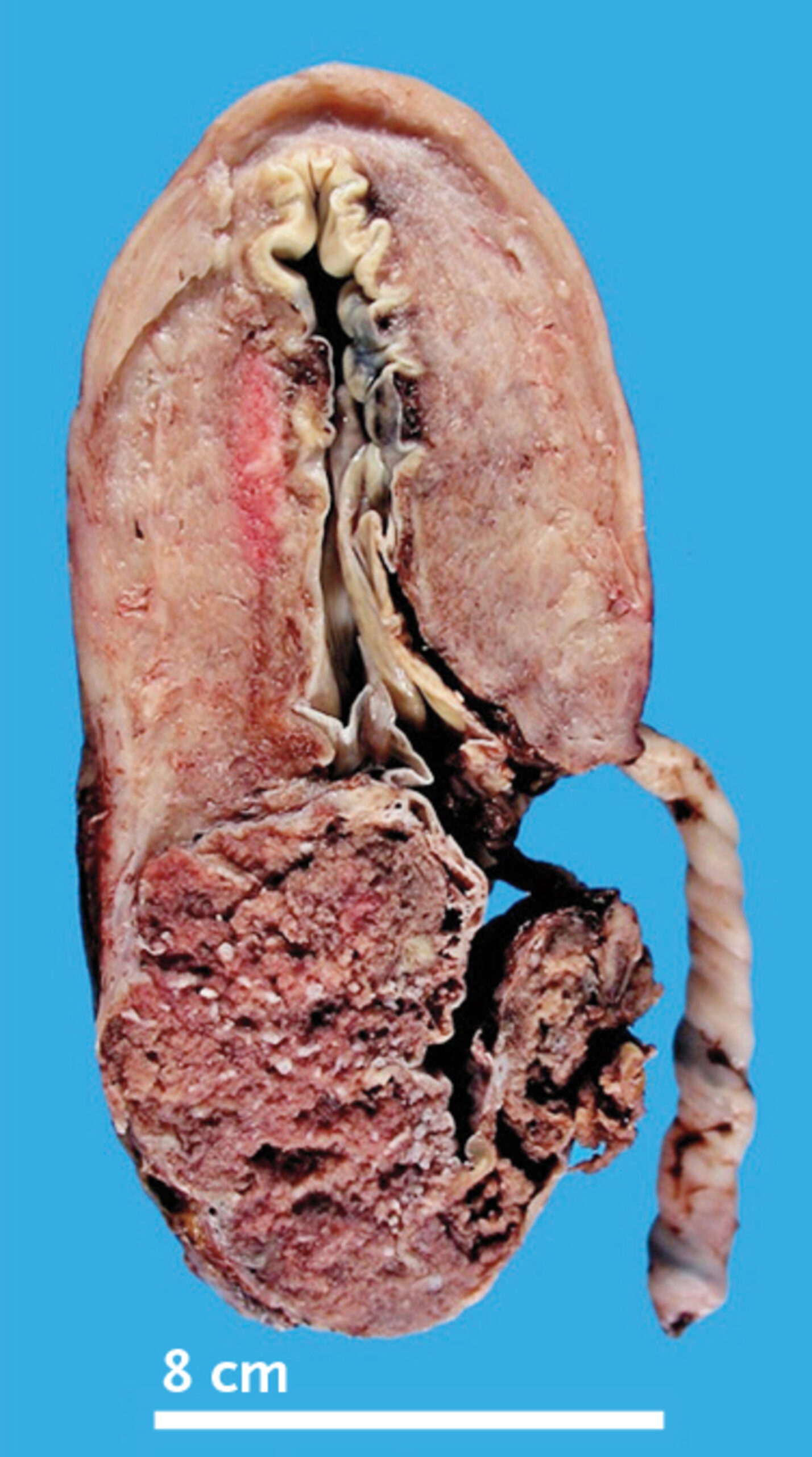 Placenta increta
