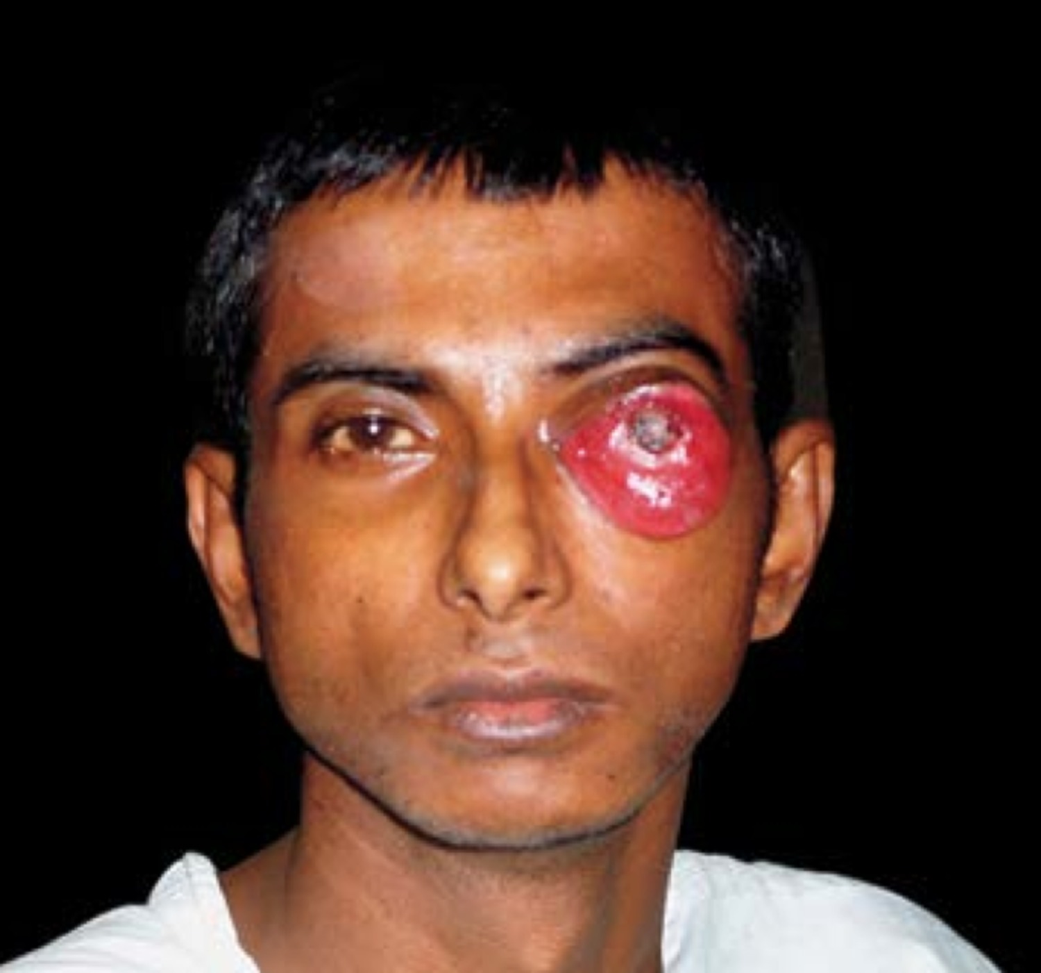 Carotid cavernous fistula