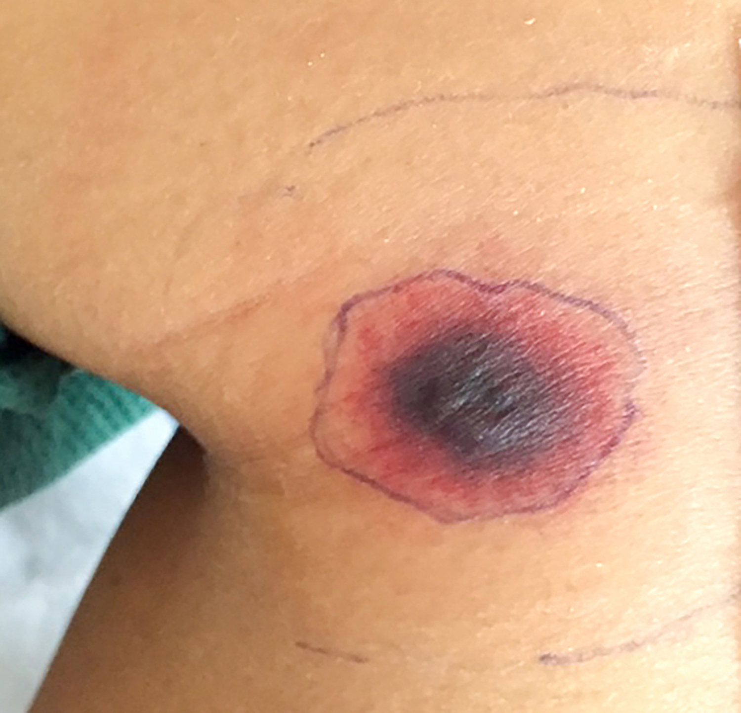 Ecthyma gangrenosum