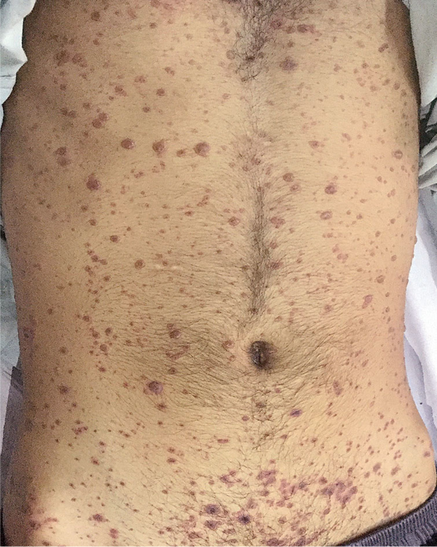 Disseminated varicella infection
