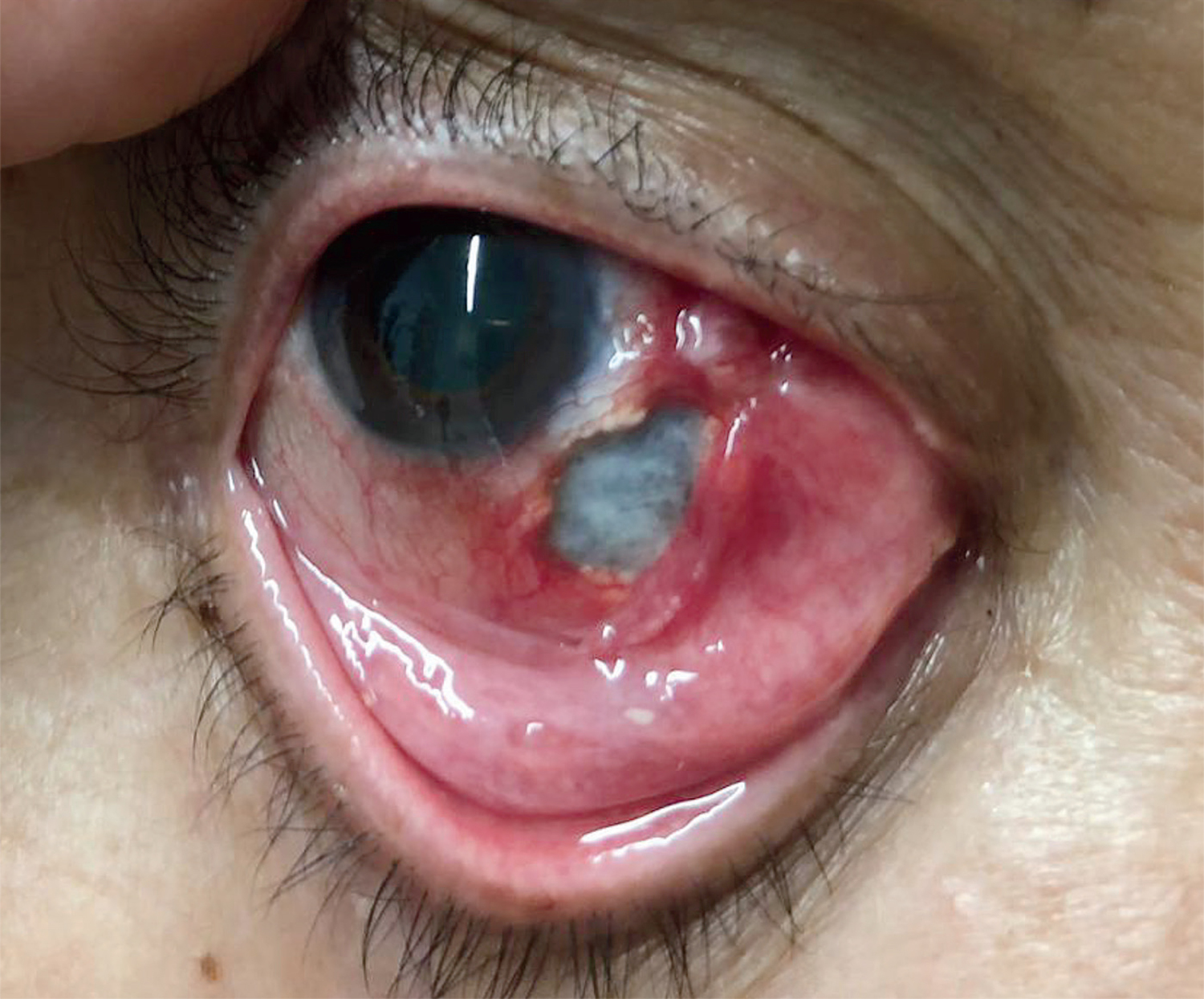Necrotizing anterior scleritis